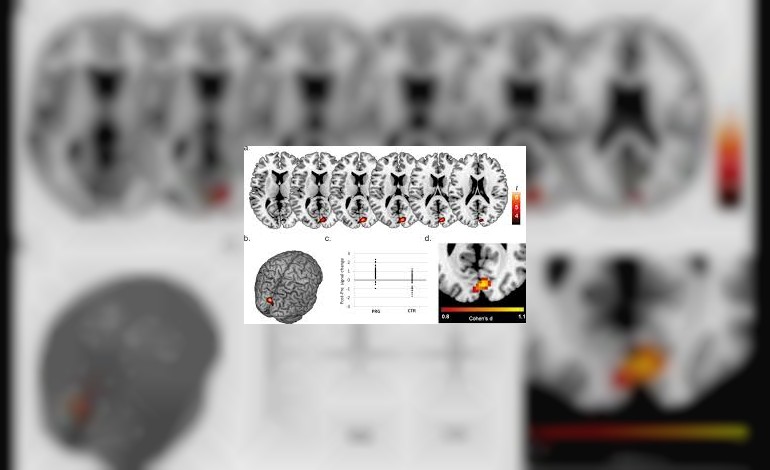 Study of pregnant woman's brain scans reveal reduced grey matter, increased steroid hormones