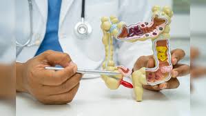 युवा पीढ़ी में अपेंडिक्स कैंसर का खतरा बढ़ रहा है: नया अध्ययन